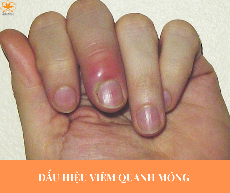 DẤU HIỆU CỦA VIÊM QUANH MÓNG